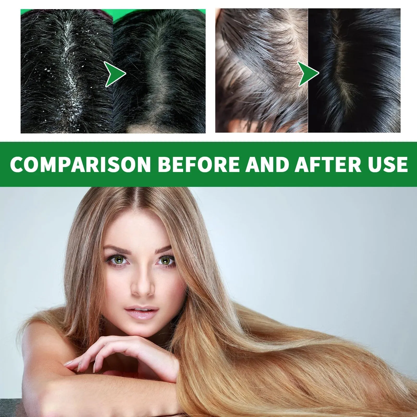 Scalp Cleansing Anti Dandruff Anti-Itching Shampoo Treatment for  Seborrheic Dermatitis & Oil Control while Strengthening Hair Roots & Smoothing Hair -32days shipping